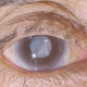 Glaucoma