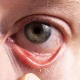 sjogrens-syndrome-about